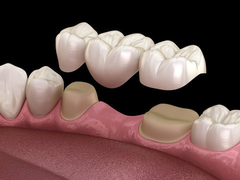 Dental crowns treatment at Ayur Dental Vizianagaram
