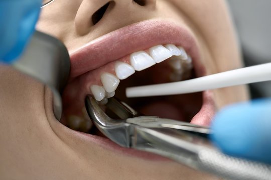 Painless extractions at Ayur Dental Vizianagaram