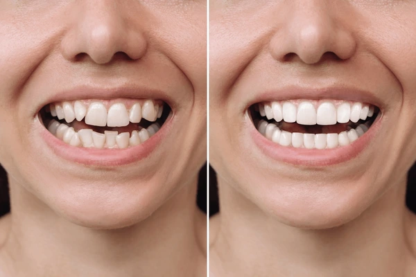 Teeth Braces treatment at Ayur Dental Vizianagaram