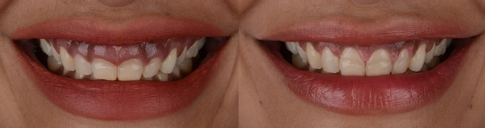 Gum Surgery at Ayur Dental Vizianagaram