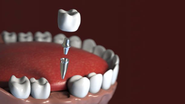 Ayur Dental Vizianagaram - Dental Implants