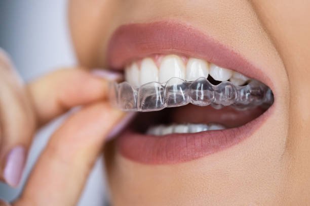 Clear Aligner treatment at Ayur Dental Vizianagaram